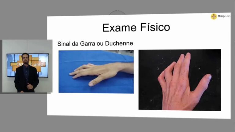 Compreendendo a Mão em Garra: O Papel do Nervo Ulnar