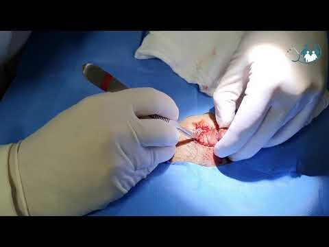 Cirurgia de Queloide na Orelha: Guia Completo