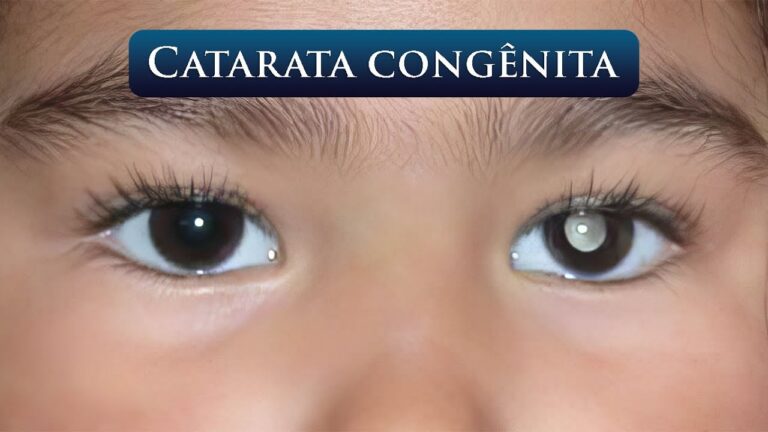 Tratamento eficaz para catarata congênita: descubra a cura