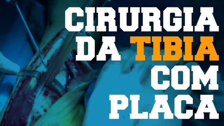 Cirurgia de Tibia com Placa: Guia Completo e Atualizado