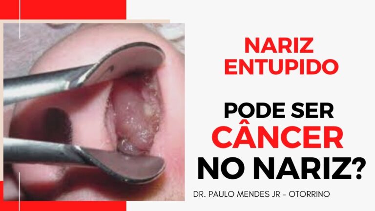 Entendendo os Tumores Nasais: Causas e Tratamentos