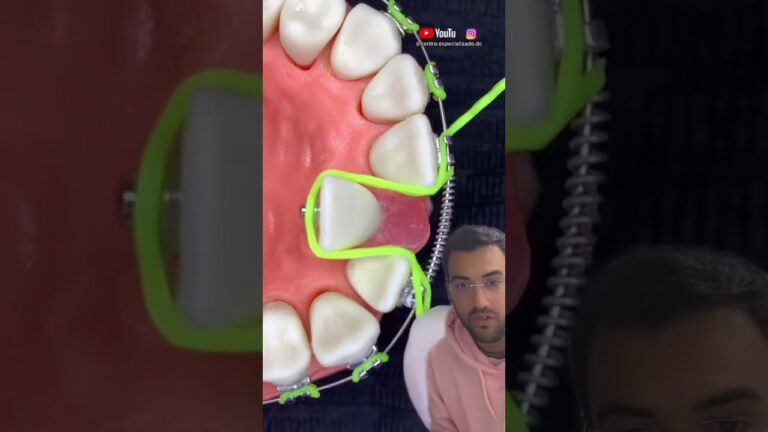Soluções para Dente Pra Fora: Tratamentos e Opções Estéticas