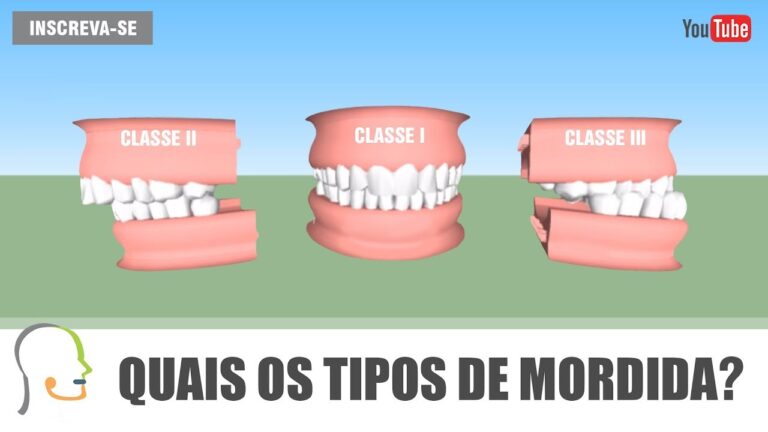 Tipos de Mordidas: Guia Completo