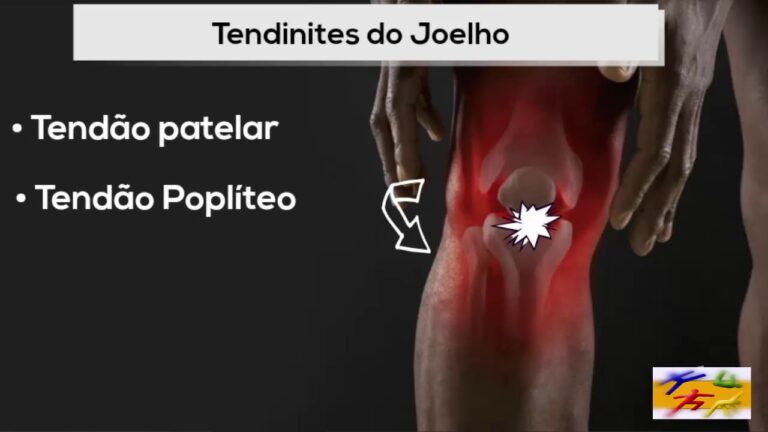 Imagens de Tendinite no Joelho: Diagnóstico e Tratamento
