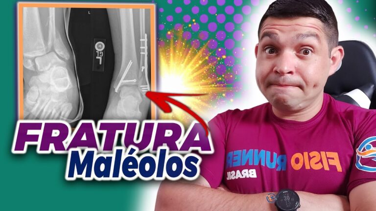 Recuperação otimizada da fratura do maleolo medial: tempo de recuperação