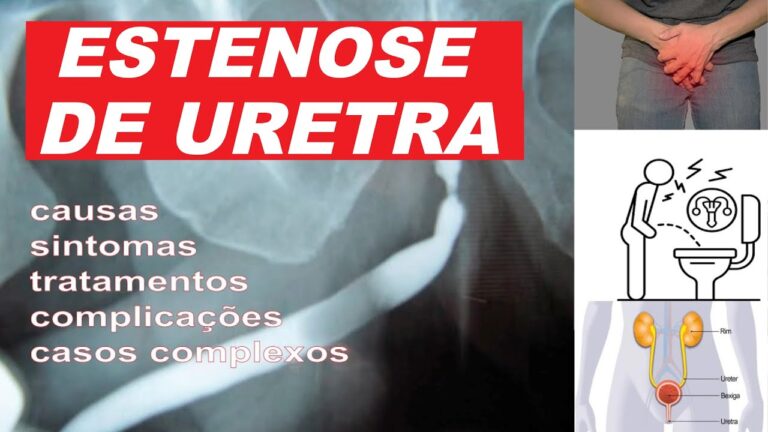 Entendendo a Estenose na Uretra: Causas e Tratamentos