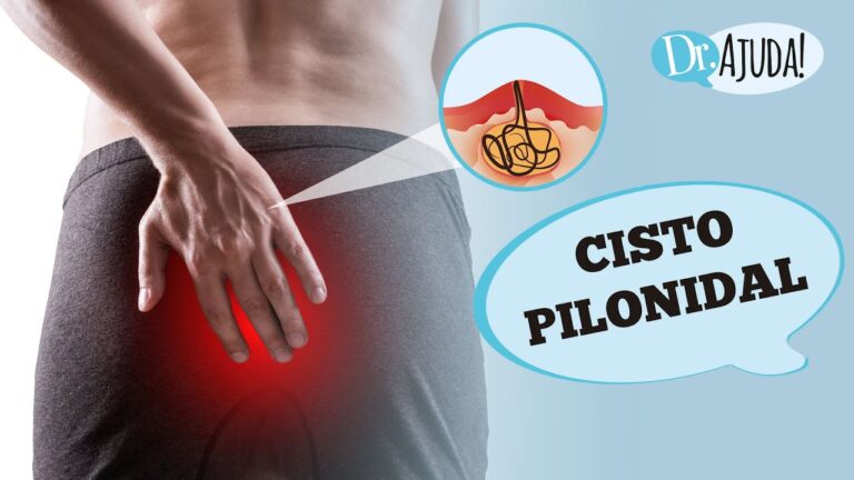 Tratamento eficaz para cisto pilonidal sacrococcígeo