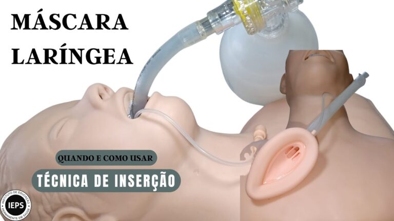 Máscara Laríngea: O Dispositivo Essencial para Ventilação