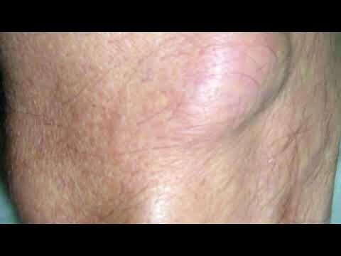 Cirurgia de Lipoma nas Costas: O Que Você Precisa Saber
