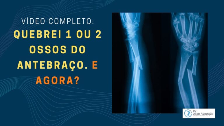 Tratamento eficaz para antebraço quebrado