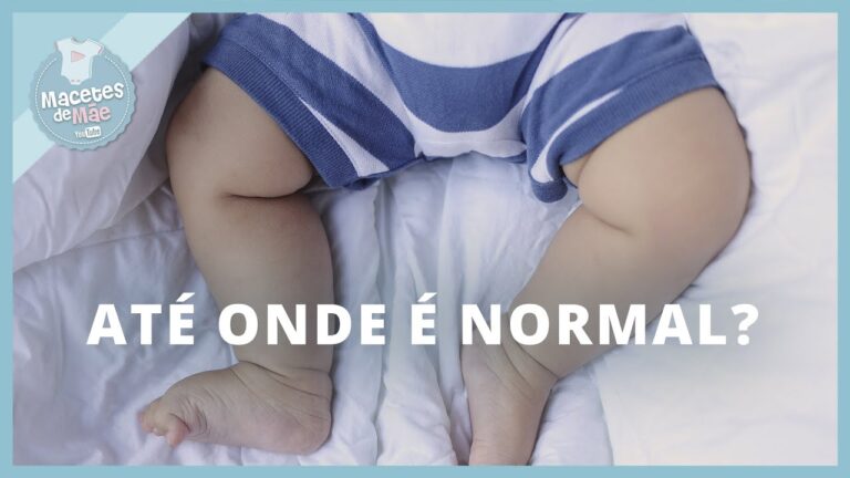 Tratamento para Perna Torta em Bebês: O que você precisa saber