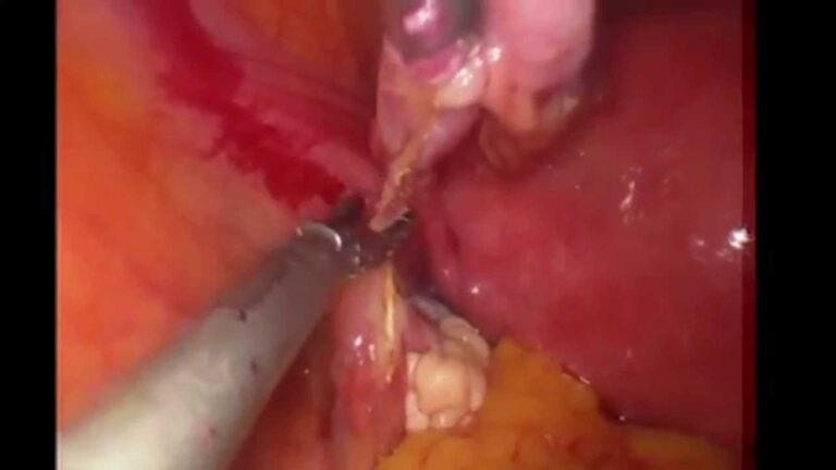 Cirurgia de remoção das trompas: o que você precisa saber