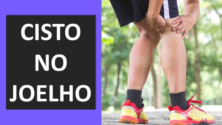 Tipos de Cisto no Joelho: Guia Completo