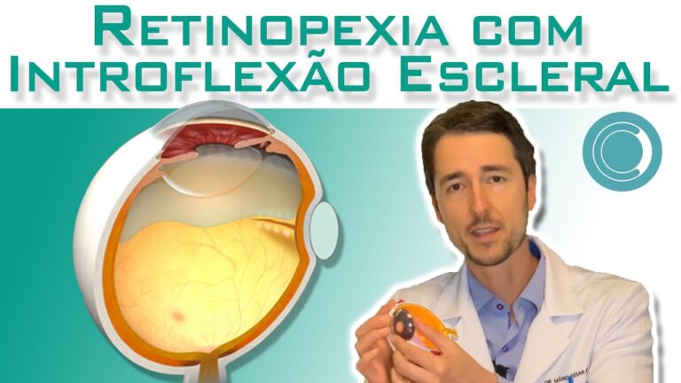 Retinopexia com introflexão escleral: uma abordagem otimizada