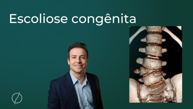Escoliose Congênita: Diagnóstico e Tratamento