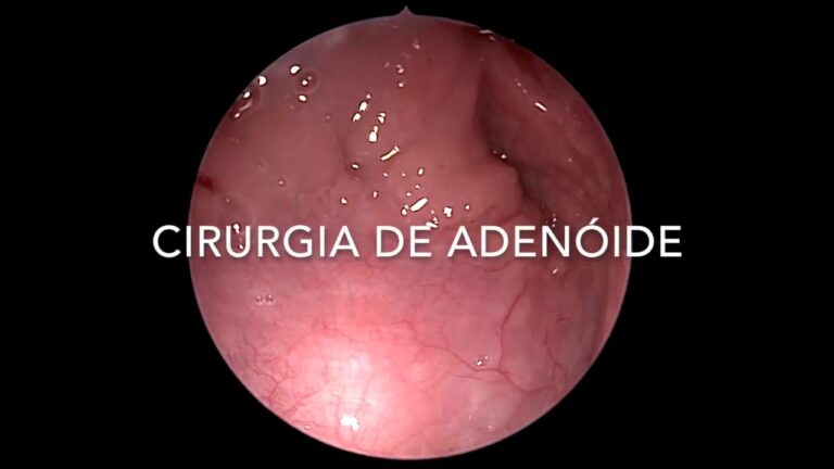 Cirurgia de Adenoide: Antes e Depois