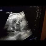 Adenomiose: Entenda o Sangramento Intenso
