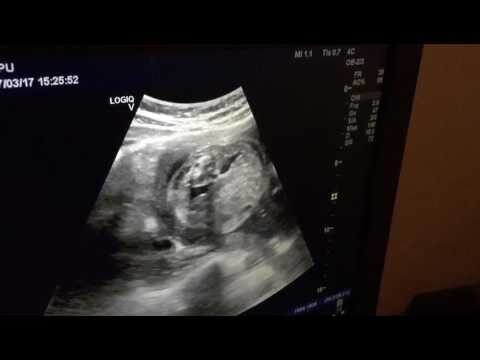 Causas de dilatação renal fetal