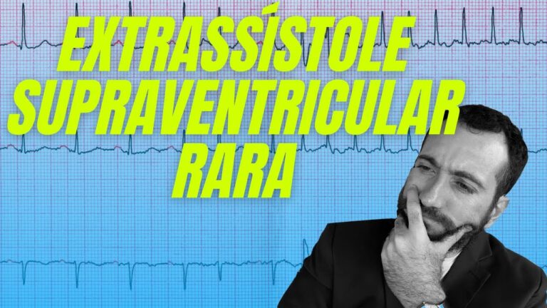Extrassístoles Atrial Raras: O Que Você Precisa Saber