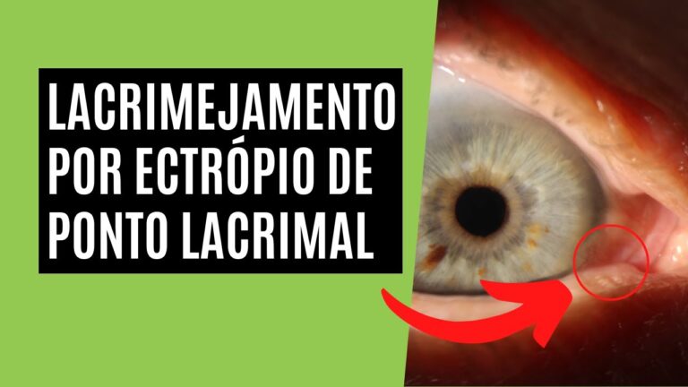 Ponto Lacrimal: Função e Tratamento