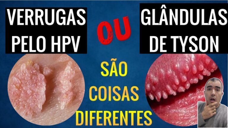 Glândulas De Tyson: O Que São E Os Problemas Que Podem Causar – QIZR