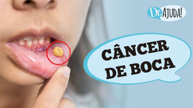 Tipos de c&acirc;ncer bucal: fotos