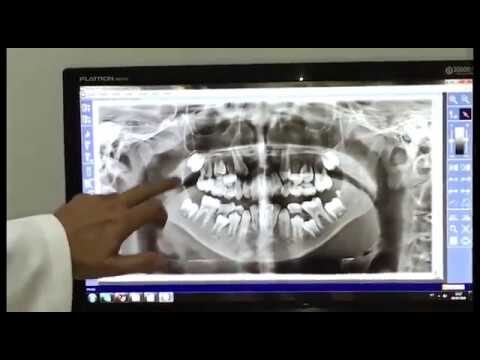 Raio X de Dente de Leite: Importância e Cuidados