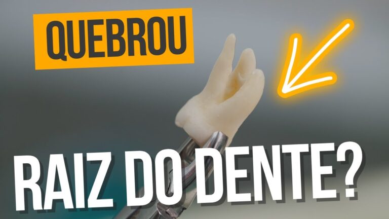 Raiz de dente quebrada: causas e tratamentos para a dor