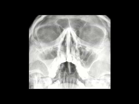 Espessamento Mucoso Maxilar: Causas e Tratamentos | Actualizado mayo 2026