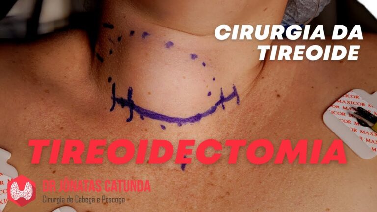 Dicas para dormir melhor após cirurgia de tireoide
