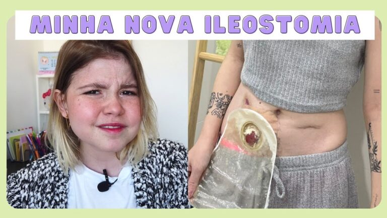 Ileostomia vs Colostomia: Qual a Diferen&ccedil;a?