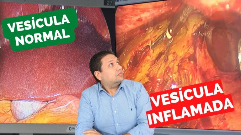 Cicatriz de Pedra na Vesícula: Causas e Tratamentos