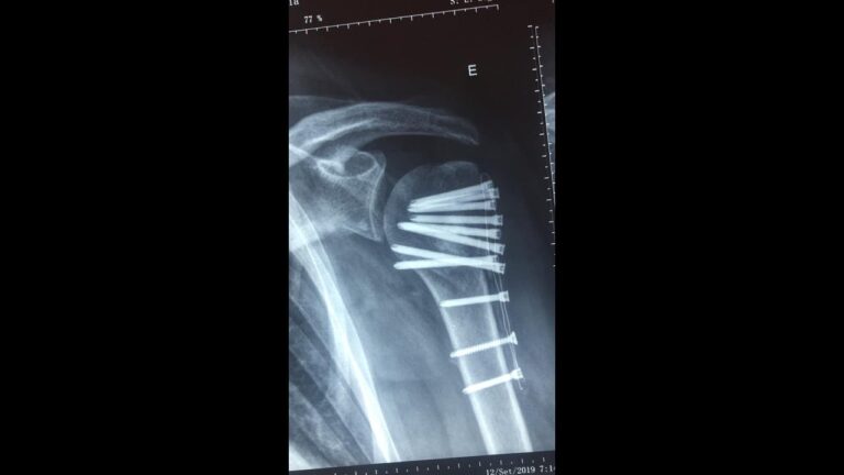 Recuperação eficiente após cirurgia de úmero com placa