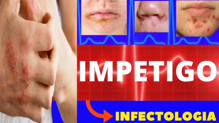 Tratamento caseiro para impetigo bolhoso: soluções eficazes