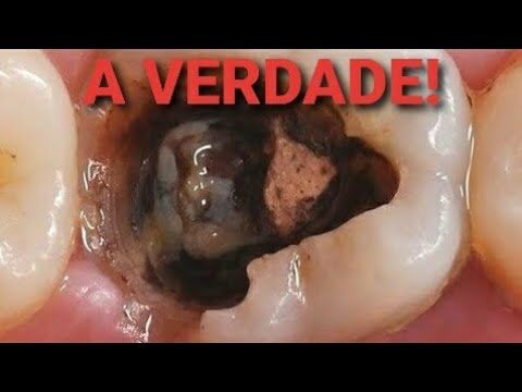 Canal ou Extra&ccedil;&atilde;o: Qual a Melhor Op&ccedil;&atilde;o para o seu Dente?