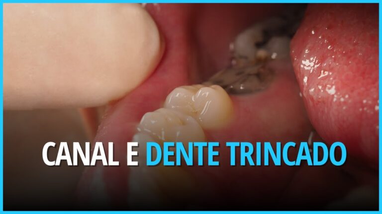A Importância da Restauração de Dente: Tudo Sobre o CID