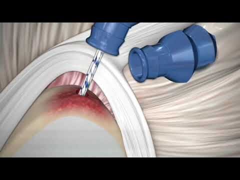 Recuperação da Lesão Labral no Ombro: Guia Completo
