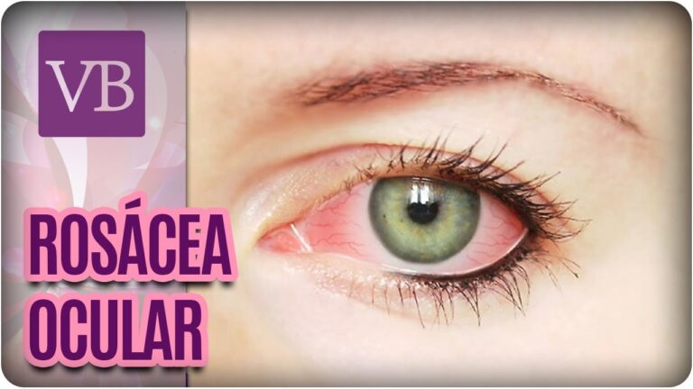 Rosacea Ocular: Sintomas e Tratamentos