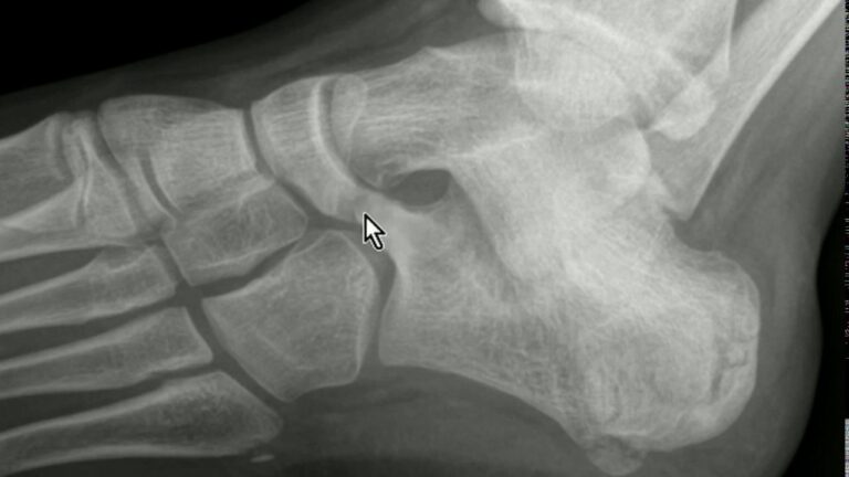 A importância da coalizão tarsal na biomecânica do pé