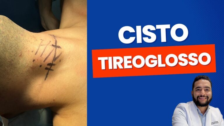 Sintomas do cisto tireoglosso: tudo o que você precisa saber