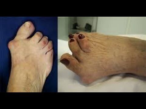 Fotos de Artrite Reumatoide nos Pés