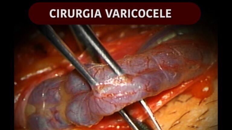 Recupera&ccedil;&atilde;o do Saco Ap&oacute;s Cirurgia de Varicocele