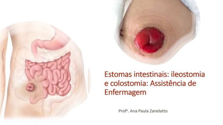 Descubra tudo sobre bolsas intestinais