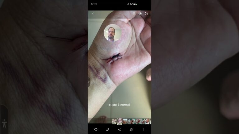 Roxidão pós-cirurgia: é normal ficar roxo?