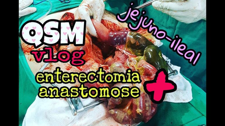 Cirurgia de remoção de fezes intestinais: o que você precisa saber