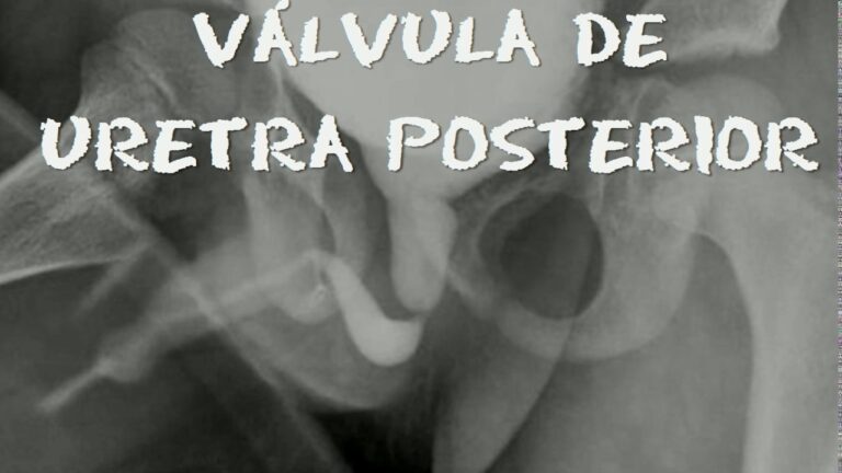 Valvula de Uretra Posterior: Diagnóstico e Tratamento