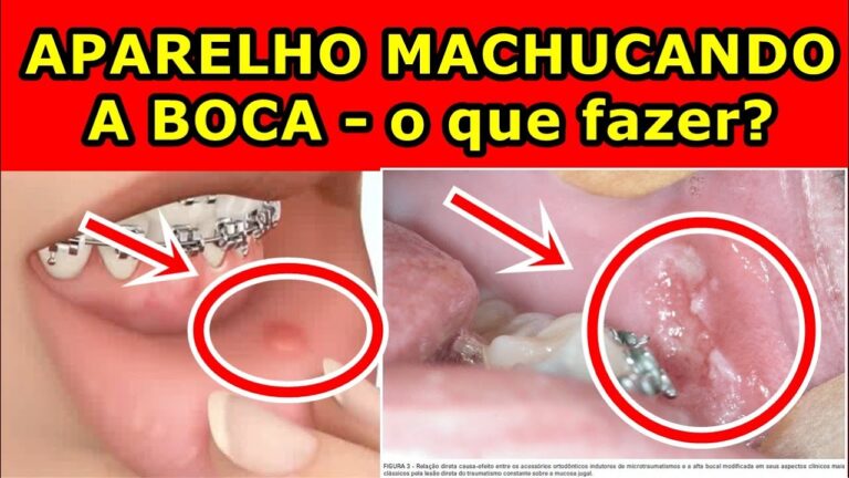 Remédios para aliviar dor causada por aparelho dentário