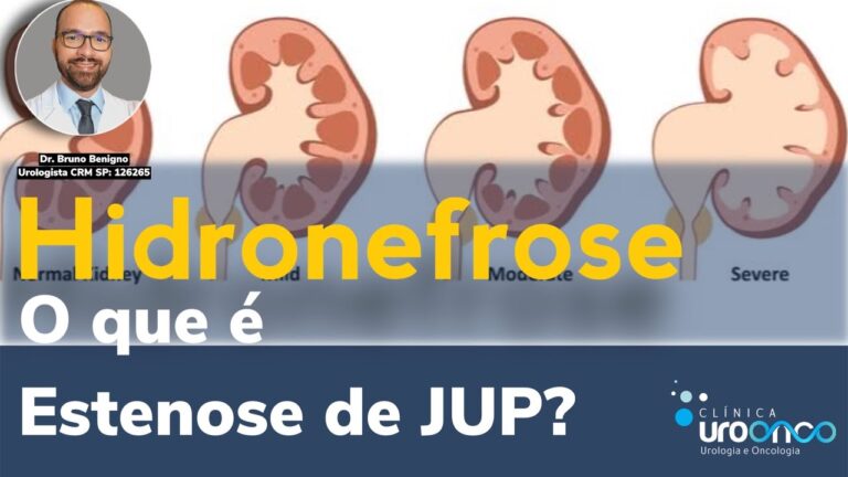 A gravidade da estenose de JUP: o que você precisa saber
