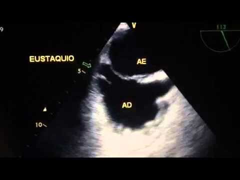 A Importância da Valva de Eustáquio