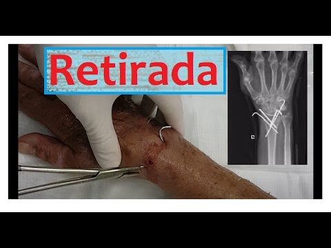 Pino no Dedo da Mão: Causas e Tratamentos